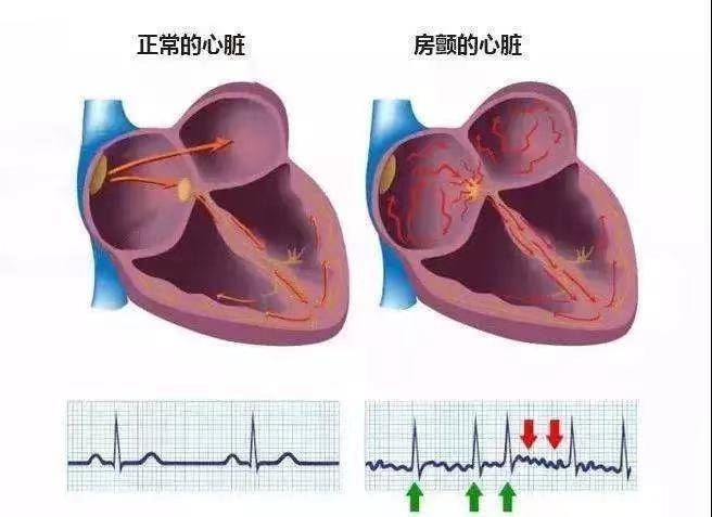 导管|房颤治疗新进展，省中医成功开展冷冻球囊导管消融术