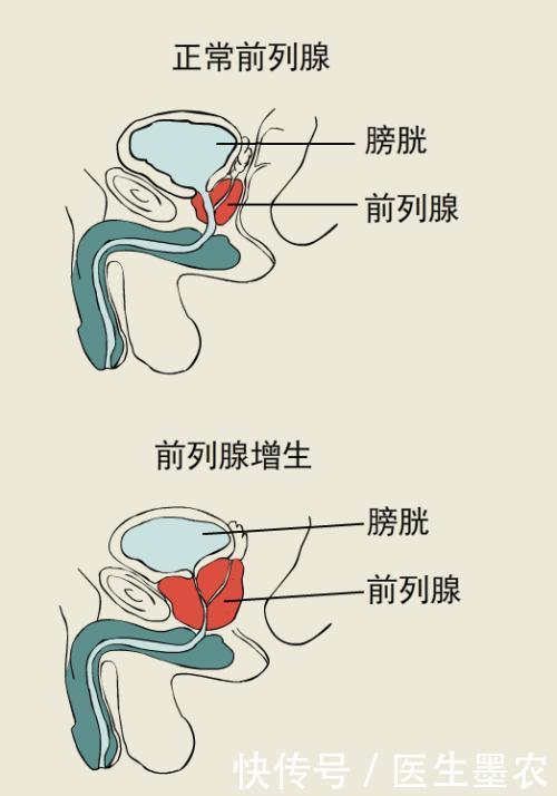  前列腺|前列腺增生会受生活习惯所影响