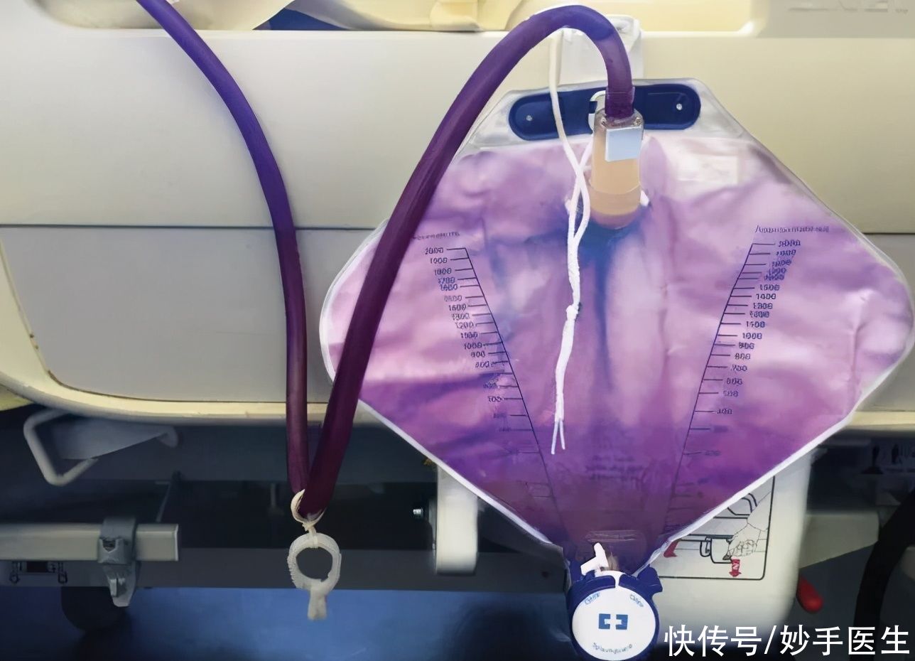 恶性|小便完别忘看一眼?出现这6个颜色要注意