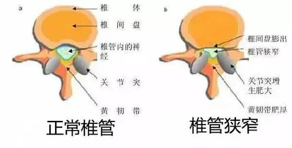 腰椎管|请几天假，腰再也不疼了