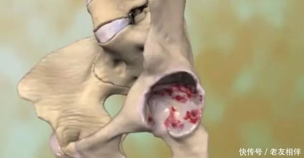 要命|髋关节疼起来真要命，到底为什么这么痛？要怎么治疗？