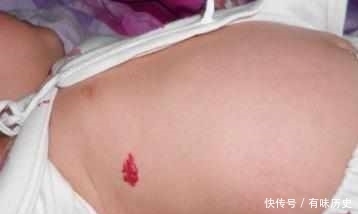 饭后立即|宝宝刚出生身上长了小红斑,婆婆不以为然,医生检查后我后悔莫及