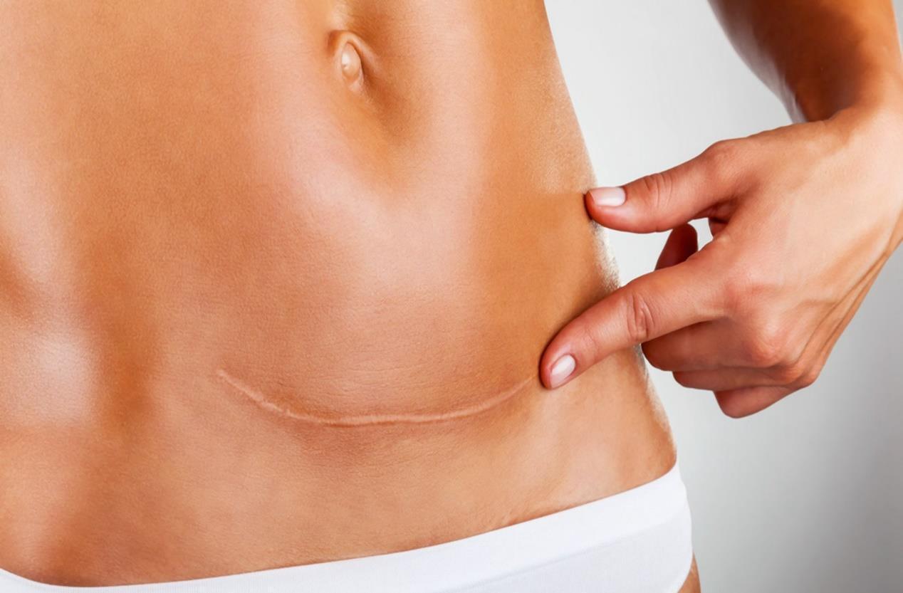 分娩|“横剖”与“竖剖”,哪个对二胎、三胎影响更大?这个选择很重要