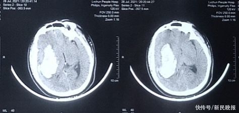神经外科|救人！上海援滇医生领衔，成功完成云南绿春县首例高血压脑出血开颅手术