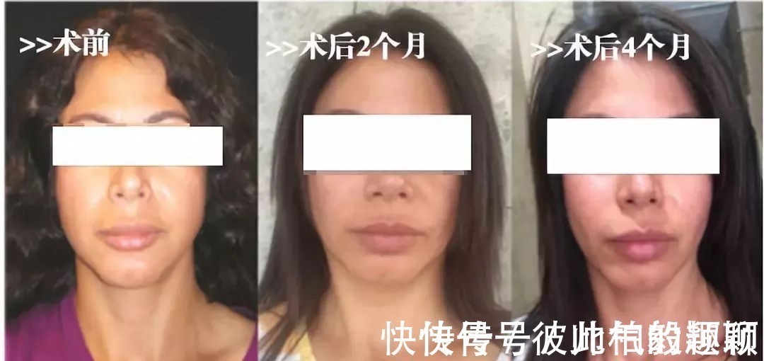 嘴角 这5个医美项目虽然很火,但很多医生不建议做!丨科普篇