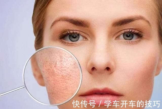 皮脂腺 油性肌肤如何护肤冬天就不需要保养护肤吗!