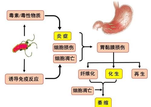 肠上皮化生|胃镜报告显示“肠化”，我会得癌吗？