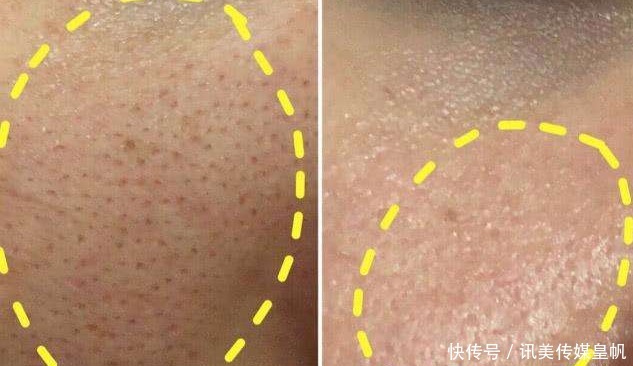 黑头|鸡蛋清能去黑头?医生提醒:2招轻松搞定草莓鼻烦恼