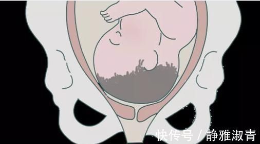 顺产|顺产“开十指”是怎么开的一组过程图让你明白什么叫为母则刚