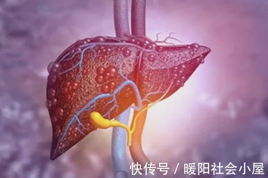 红血丝|眼睛出现这4种情况，可能是肝脏在向你求救，别不当回事！