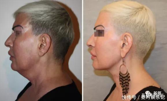 半个娱乐圈女明星脸上都有的这个坑,真的是线雕的锅吗?