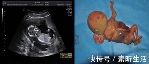 畸形|胎儿畸形高发期,安全度过孕初期,孕妈们就可以安心等待分娩了