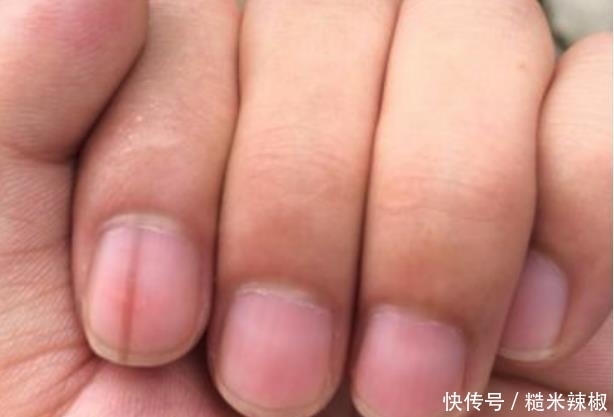 指甲上出现竖纹，主要和3个问题有关，别再忽视
