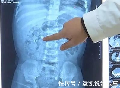 冲泡|15个月宝宝被查出“结石”,因父母冲奶粉行为错误,伤害了娃