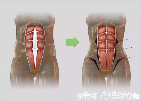 什么是腹直肌分离宝妈们如何修复腹直肌分离而拒做小腹婆呢