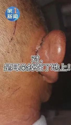 医院|老张从树上坠下,醒来后发现耳朵在自己手里