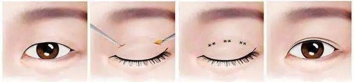 增生|济南海峡整形：做双眼皮会留疤吗？