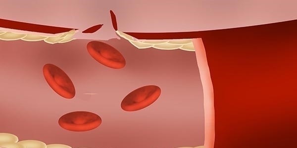 柚子|得了高血压的人,是不是不能继续喝酒了?若是喝了,会怎么样?