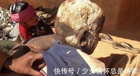 身体|小男孩11岁身体开始硬化成石头?专家:完全束手无策!