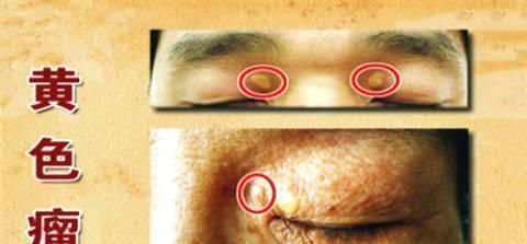 血脂异常|心血管院士开水里加1勺,连喝10天,血管干净、高血脂不攻自破
