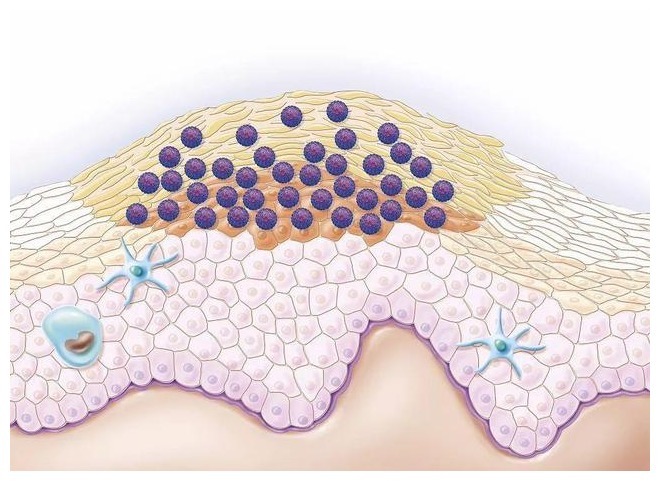 宫颈|身体这几处长“疙瘩”,或是感染HPV,医生女性做2事,护宫颈