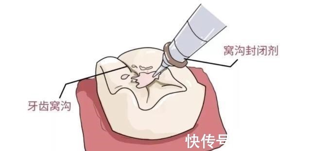 龋齿|4岁男孩牙齿几乎全黑6岁前,不要让孩子自己刷牙!