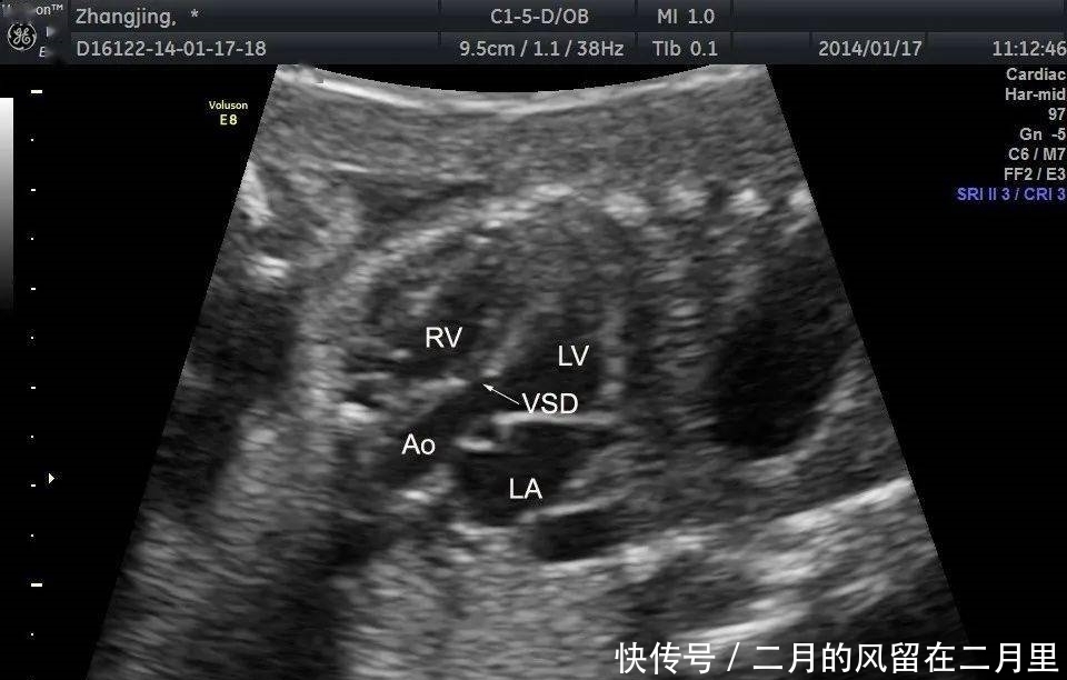 胎儿室缺,超声医师心中的痛