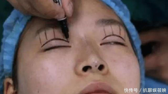 手术|做过双眼皮手术的年轻人,老了以后眼睛会怎么样?看来是这个道理