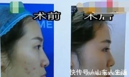 分手|90后女孩割完双眼皮,男朋友和她提分手:你像是30岁