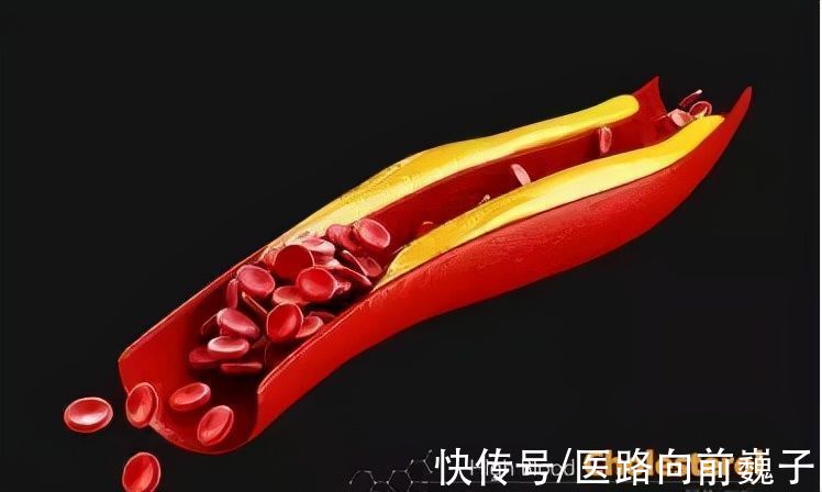 不良习惯|45岁男子血液粘如粥，深夜脑梗离世！原因竟然是长期吃这种食物