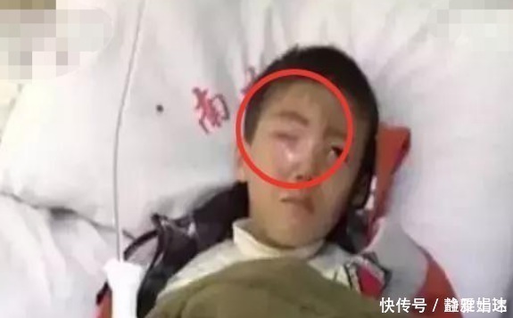 眼睛|8岁男孩20分钟眼睛被“熔化”，这种东西你家也有，父母要小心