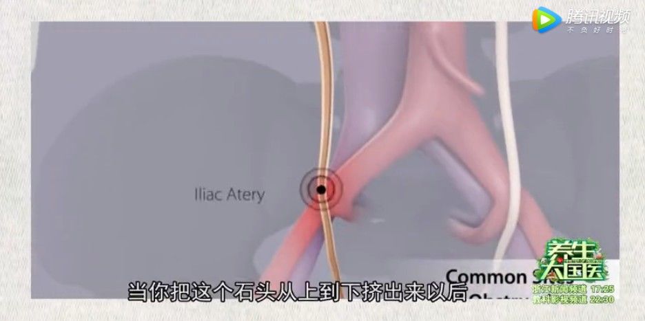 器官|这种隐藏在身体里的小石头是“沉默的杀手”，不痛不痒却能破坏整个器官！