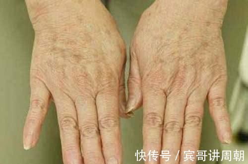 多酚化合物|无论男女开始衰老，多从手开始！手上出现3异象，说明衰老将至