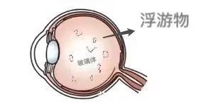 防范|权威提醒:近视度数不断增加或致盲,高度近视需引起重视和防范