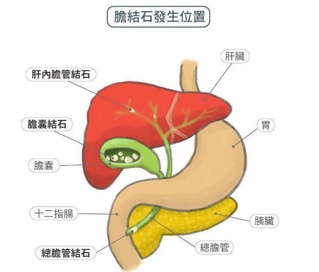 丰隆穴|血脂高的人,眼睛可能有3个症状,若没有,说明血脂控制的还不错