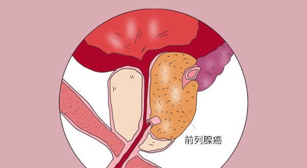 筛查|哪些原因容易导致癌症复发？医生在文中一一列出，帮大家预防