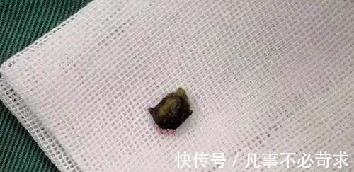 父母|8岁男孩耳朵疼痛难忍,父母带孩子去检查,取出的东西让爸妈崩溃