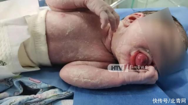 章樱|罕见！杭州一女宝宝出生时口含“龙珠”！竟是……