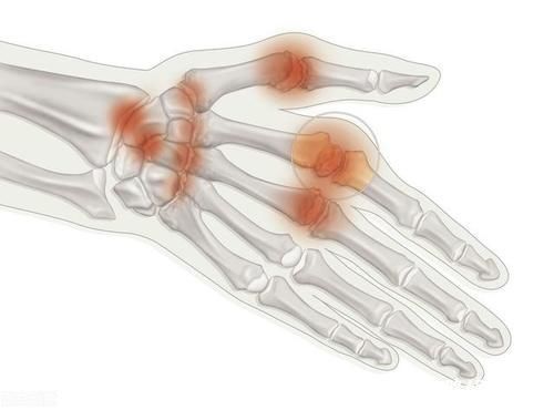 风寒湿|“风湿病”不可怕，中医教你吃掉它，一只鸡两味药，吃掉风湿病