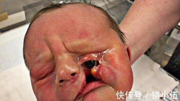 眼睛|小男孩出生时父母吓一跳,眼睛竟然长在脸上,长大后了不起!