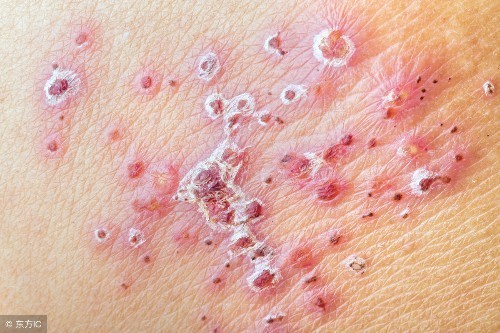 蛇缠腰|“蛇缠腰”带状疱疹，疼起来要人命，1个小妙招解决问题，很管用