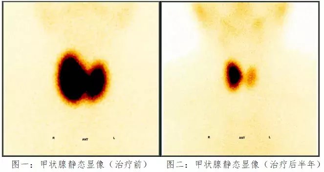 王女士|甲亢复发，“碘”到为止