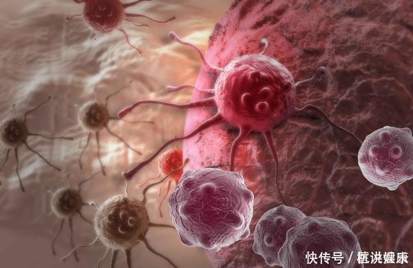 上皮|什么叫“癌前病变”这四类常见的癌前病变,现在了解还不算晚