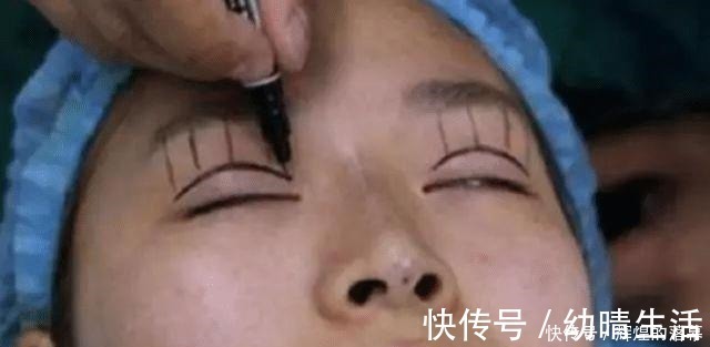 年轻人 做过双眼皮手术的年轻人,老了以后眼睛会怎么样看来是这个道理!