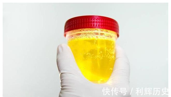 年轻人|越来越多年轻人被尿毒症盯上?哪些行为可能会伤害肾?