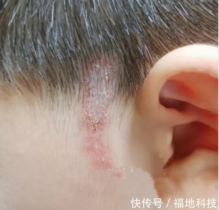男孩|6岁男孩只因惹了这个小家伙脸部皮肤溃烂。麻烦就在“举手之间”