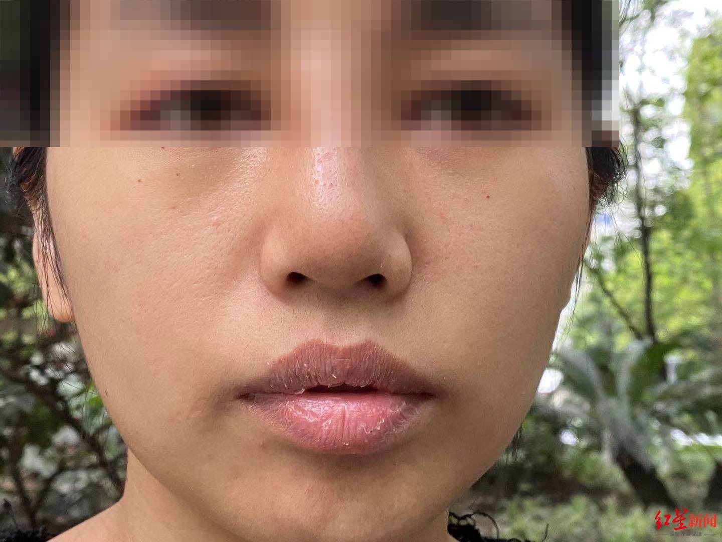 美容机构回应女子被整歪鼻子:只能修复,退3000元