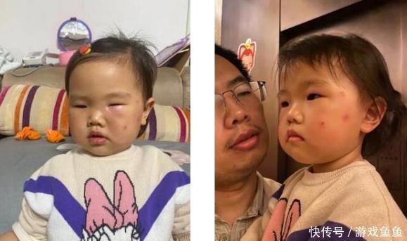 花露水|宝宝被蚊子咬成“大耳朵图图”,又疼又痒还留疤,怎么处理最好?