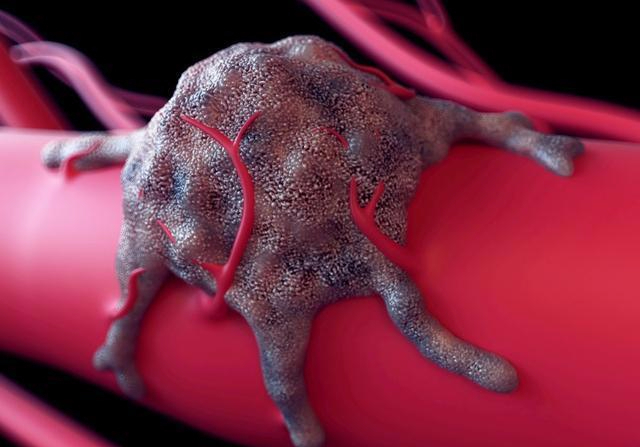 肺结节|体检查出结节、息肉、囊肿，哪个才是癌症前兆帮你做了3个分析