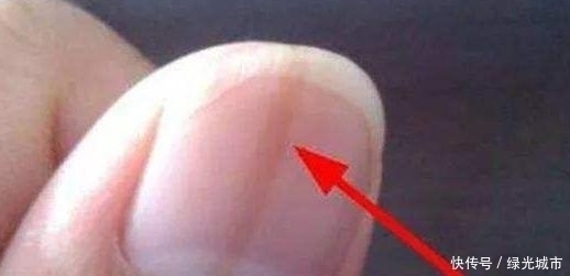 不在乎|指甲上发现有“竖纹”,可能是这4种“情况”,别傻傻的不在乎